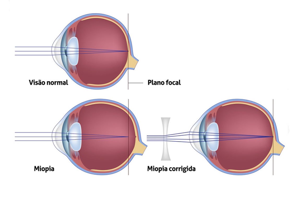 miopia astigmatismo e hipermetropia diferença)