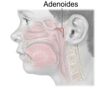 Adenoamigdalectomia