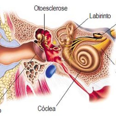 Estapedectomia