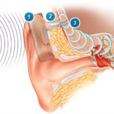 Prótese implantável de condução óssea