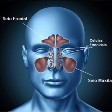 Cirurgia Funcional dos Seios Paranasais