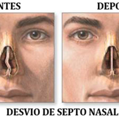 Septoplastia