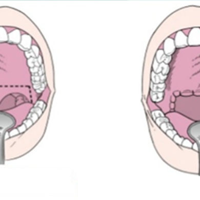 Uvulopalatoplastia