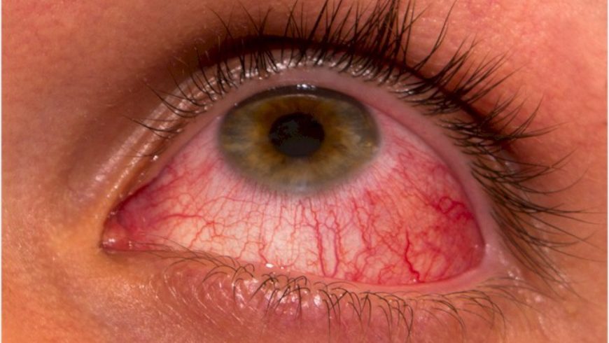 Ceratite microbiana: doença ocular que pode levar à cegueira