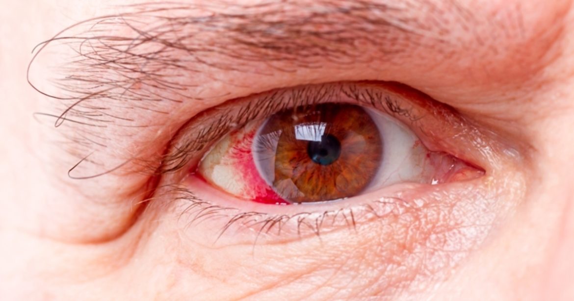 glaucoma.jpg