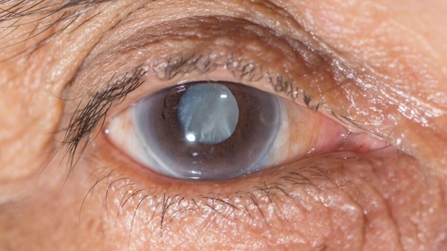 Quando o glaucoma vem como consequência de outra doença