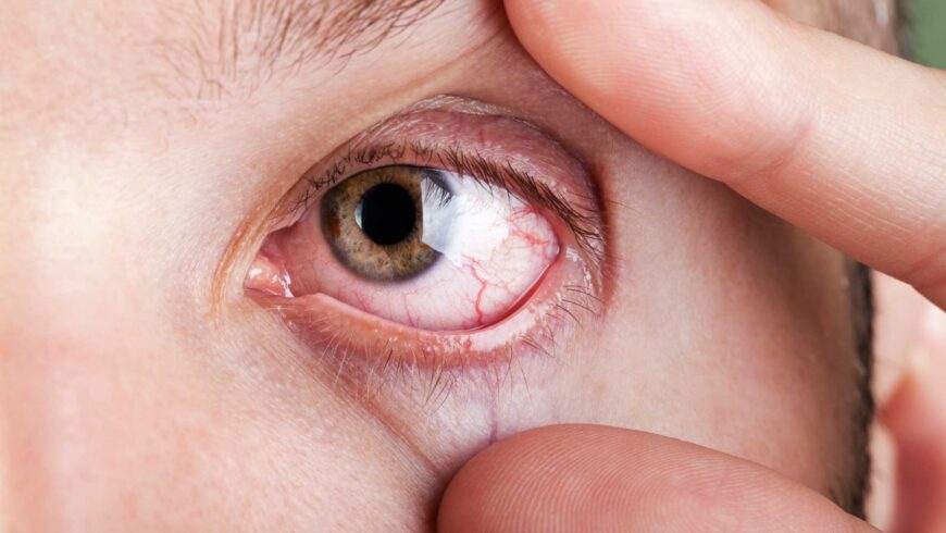 10 dicas úteis para evitar a alergia ocular