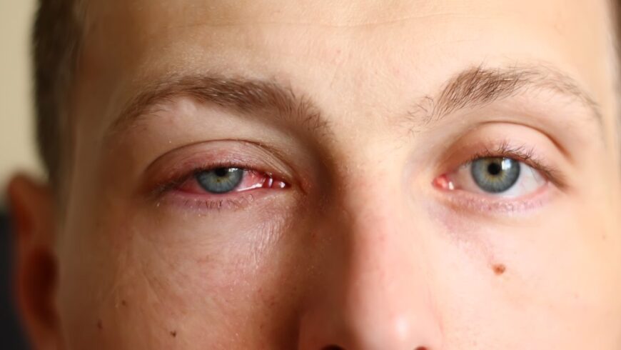 Alergias oculares: a prevenção com base no tratamento